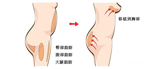 自体脂肪隆胸适合哪些人?|尽美网