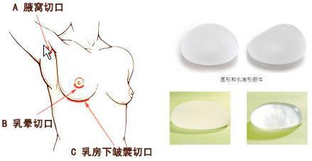 假体隆胸和自体脂肪隆胸哪种*?*吗?