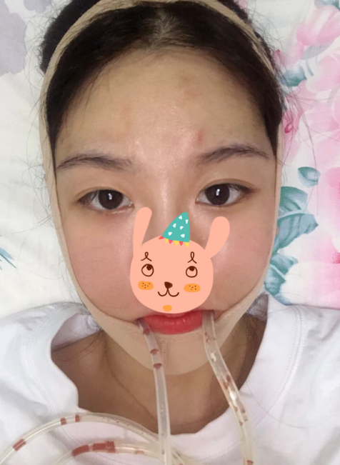 在南京友谊医院做的下颌角切除,*果很好