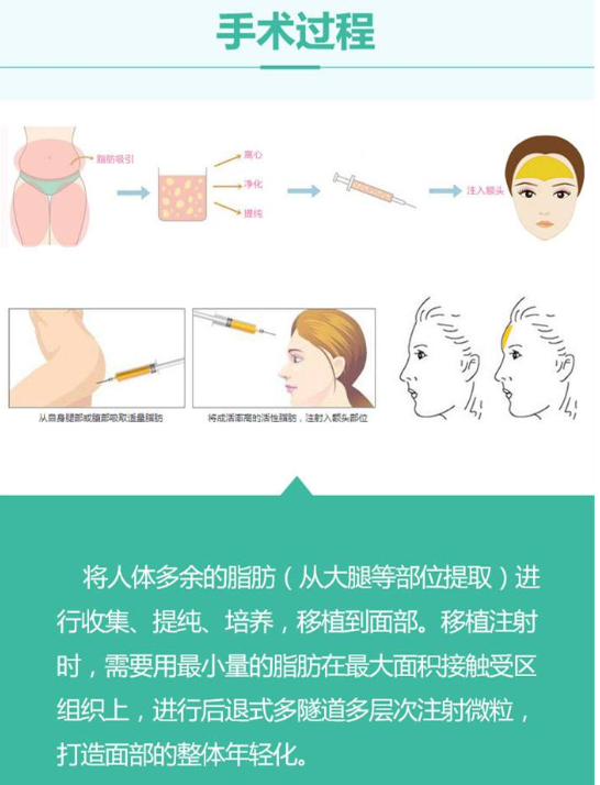 合肥吸脂、自体脂肪填充做的好的医生测评