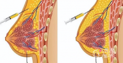 武汉假体隆胸哪个