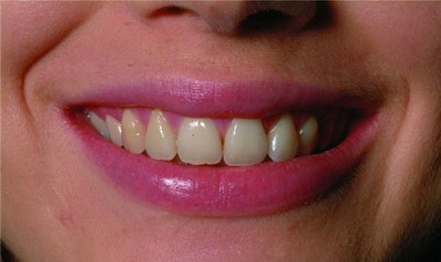 牙套可以有效治疗打鼾吗,效果好不好,复发「牙套整形」_相关医院推荐