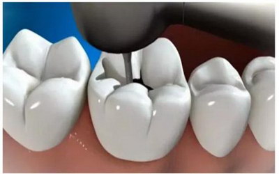 牙套套上吃东西牙齿酸是正常的吗「牙齿整形」_相关医生推荐