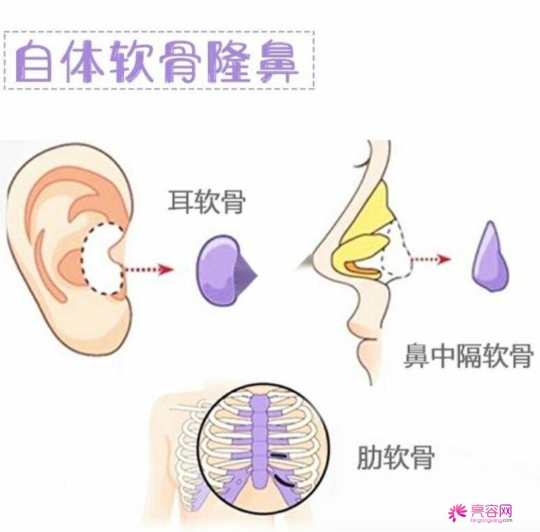 浏阳人民医院整形科怎么样？专家团队信息+隆鼻真实果反馈