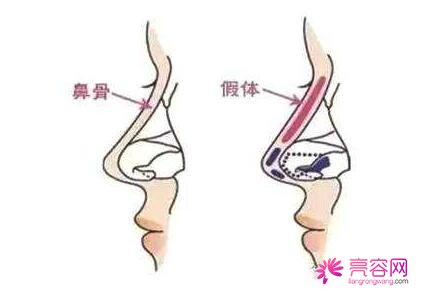 北京王志坚做鼻子果怎么样？医生跟人信息+隆鼻真人真实案例