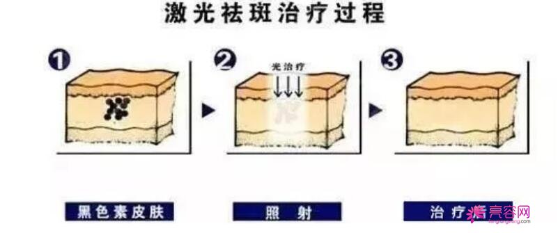 祛斑较好的方法是什么呢？附上各种祛斑方法详细介绍！