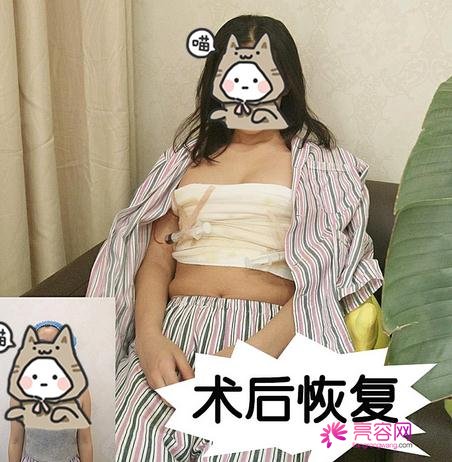 乳房整形前后对比，内附乳房整形术后恢复记录贴