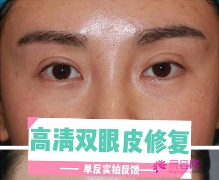 白永辉毁眼案例有吗？医生技术怎么样？附上真人双眼皮修复真实案例