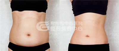 腹部吸脂有没有副作用?