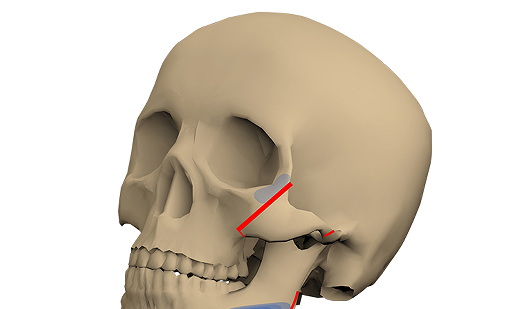 北京圣嘉新张立天:颧骨手术这样做可以避免下垂 北京圣嘉新张立天:颧骨手术这样做可以避免下垂