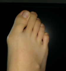 不手术矫正大脚骨可以治好吗 不手术矫正大脚骨可以治好吗