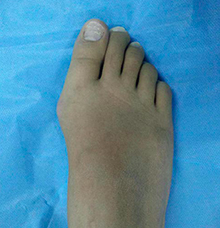 不手术矫正大脚骨可以治好吗 不手术矫正大脚骨可以治好吗