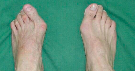 超微创矫正拇外翻治疗效果如何 超微创矫正拇外翻治疗效果如何