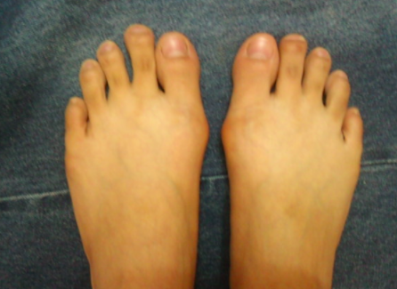 产生大脚骨的原因 产生大脚骨的原因