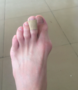 产生大脚骨的原因 产生大脚骨的原因