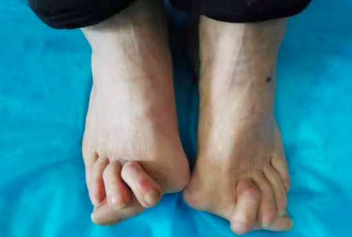 产生拇外翻的原因 产生拇外翻的原因