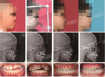 自动持续经缝牵引成骨技术矫正儿童面中部骨骼发育不全 赵振民