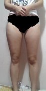【抽脂减肥+大腿抽脂】大