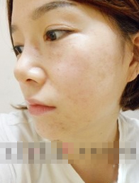 激光嫩肤