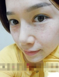 光子嫩肤
