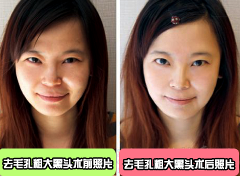 毛孔粗大有黑头怎么办,毛孔粗大怎么办,如何改善
