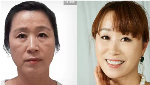 opt嫩肤多少钱,opt嫩肤价格