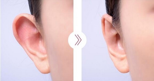 耳廓畸形是怎么形成的
