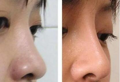 膨体隆鼻一个月可以做修复吗