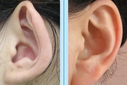 修复耳朵畸形费用