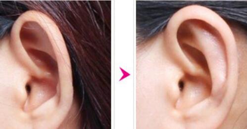 鼻子做了假体耳软骨可以保持几年