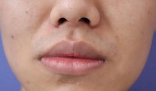 玻尿酸丰唇多久可以恢复正常_玻尿酸丰唇多久最自然