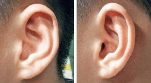 耳朵畸形整形需要多少钱
