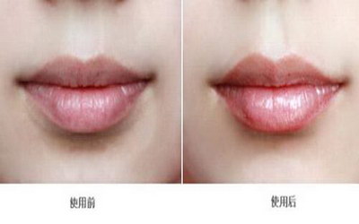 治疗唇腭裂：多少钱才能拥有完美的双唇？_唇腭裂3度手术多少钱？