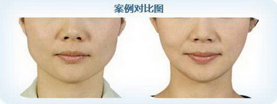 如何化脸颊两侧的红肿?_瘦脸针造成的脸颊凹陷能恢复吗